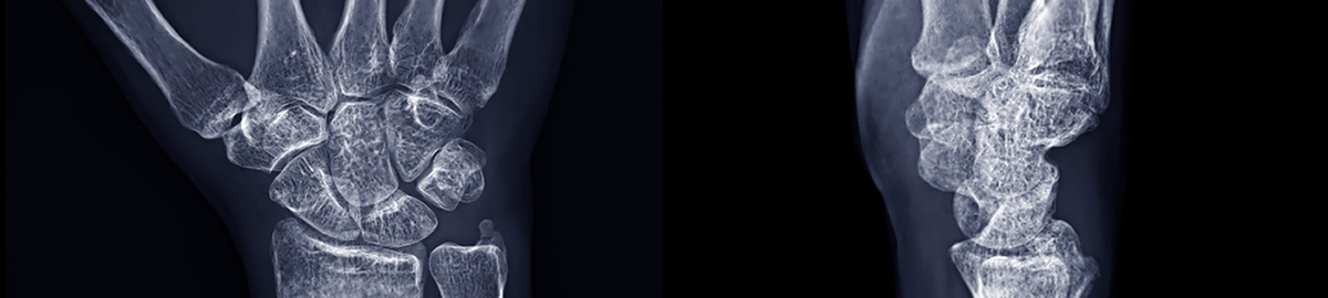 손목 관절 엑스레이 검사 이미지